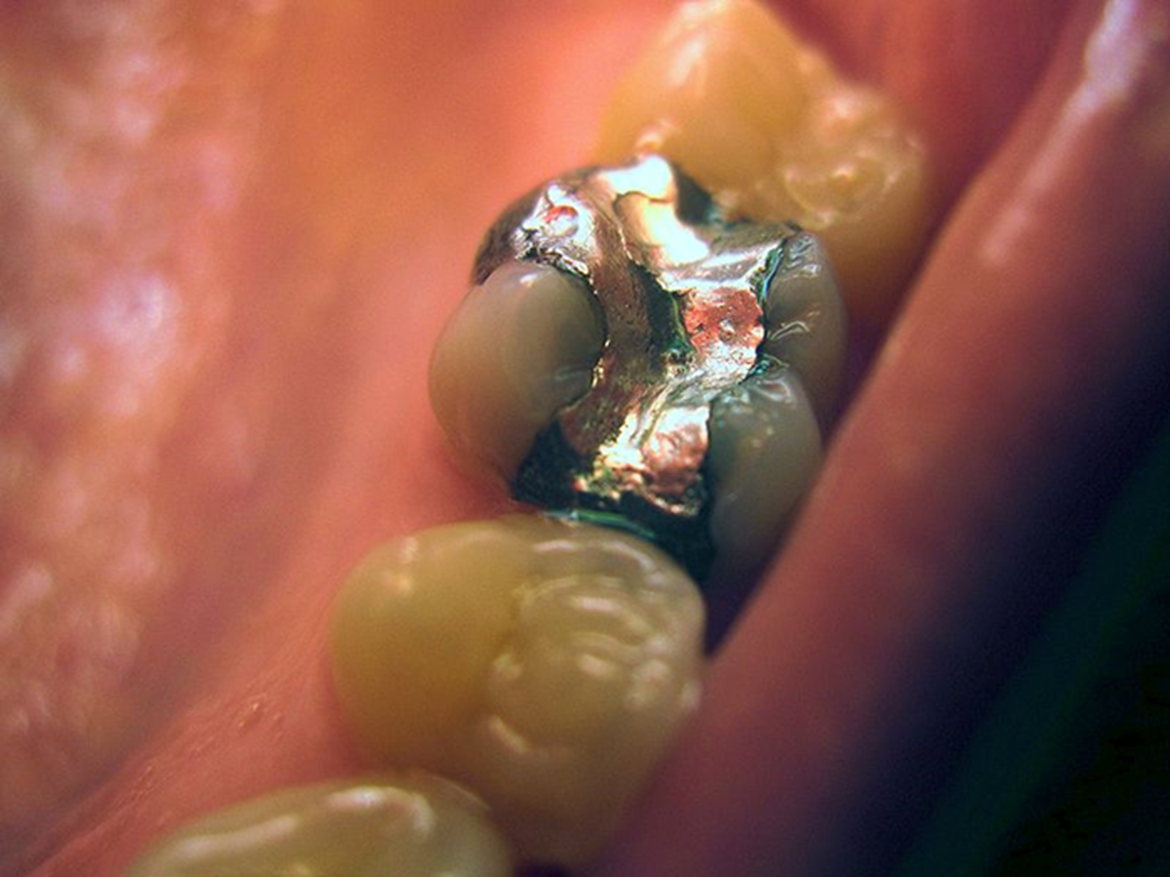 Figure a: Amalgam filling containing mercury. OSPAR works to reduce mercury losses from dentistry and also atmospheric mercury from crematoria (Source: Kauzio, Wikimedia Common)